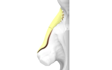 Custom SOFIT implant