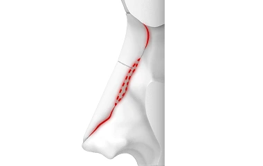 Off-the-shelf implant