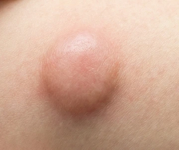 表皮嚢腫