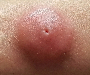粉瘤