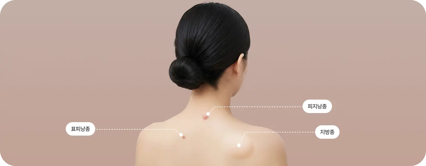 良性腫瘍